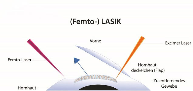 Schema Femto-LASIK: Hornhaut, Flap sowie Femto- und Excimer-Laser