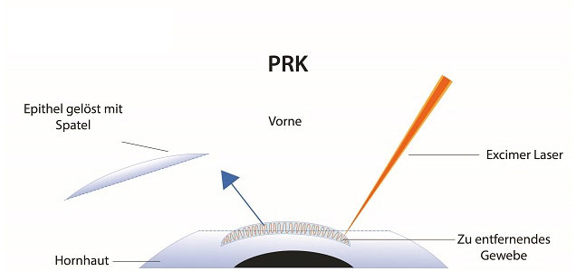 Schema PRK: Epithel mit Spatel gelöst, Excimer-Laser an der Hornhaut
