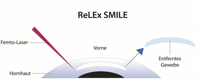 Schema ReLEx SMILE: Femto-Laser und Entnahme des Lentikels aus der Hornhaut