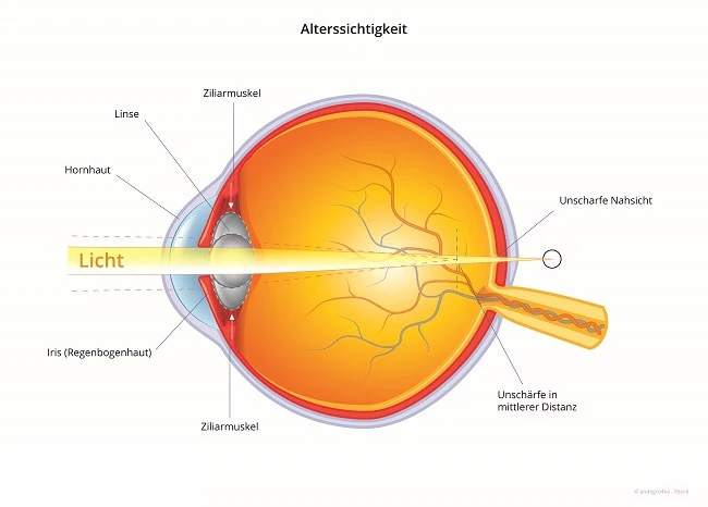 Schema Alterssichtigkeit (Presbyopie): Strahlengang im Auge
