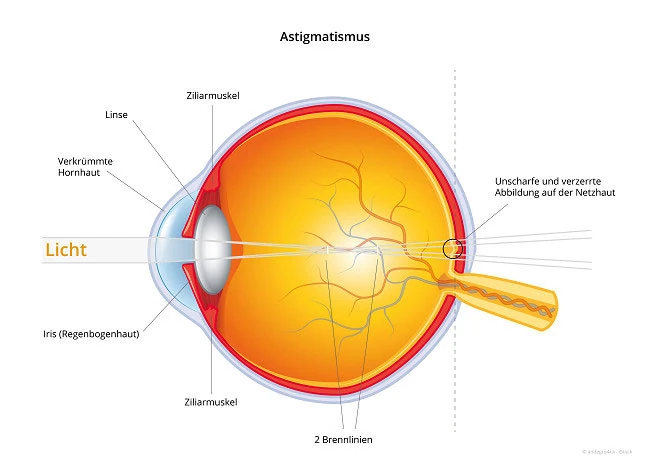 Schema Astigmatismus: Strahlengang im Auge