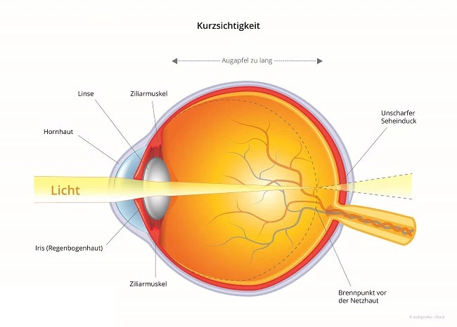 Schema Kurzsichtigkeit (Myopie): Strahlengang im Auge