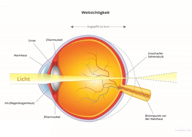 Schema Weitsichtigkeit (Hyperopie): Strahlengang im Auge
